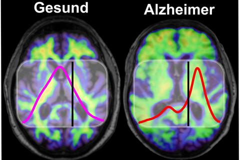 Im Gehirn von Menschen mit Alzheimer kommt es zu Protein-Ablagerungen. Gesunde und krankhafte Amyloid-Proteine absorbieren Infrarotlicht unterschiedlich und können mit bildgebenden Verfahren sichtbar gemacht werden (rechts). Foto: K. Gerwert, A. Nabers/RUB.