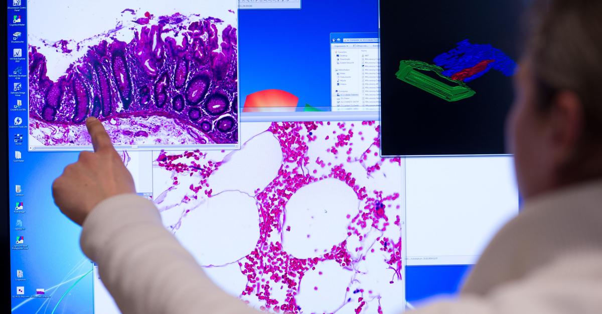mRNA cancer vaccine: After soaring high, setback for Mainz-based BioNTech