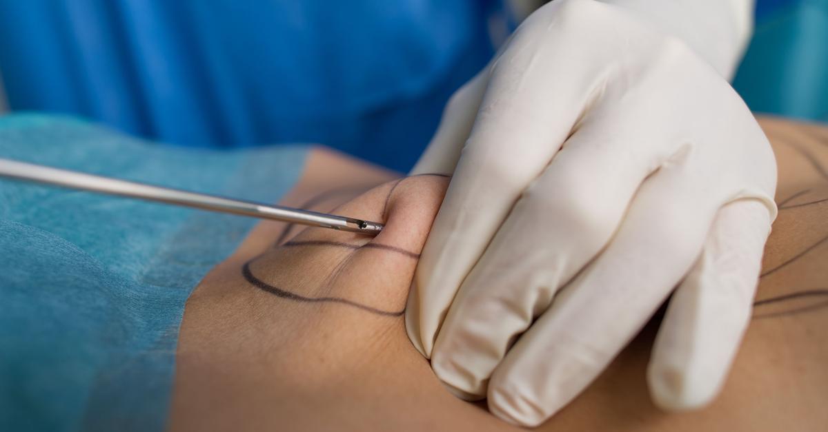 Liposuction: Where the new health insurance regulations for lipedema still ...